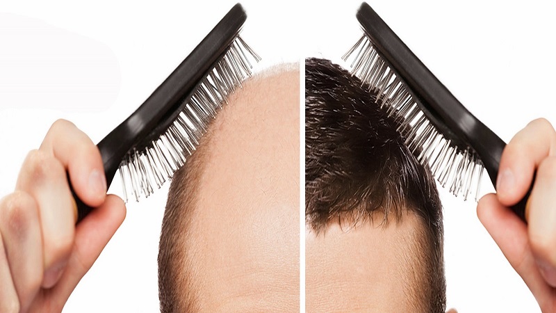 کاشت مو به چه صورتی انجام می شود و بهترین و جدیدترین روش های پیوند مو چگونه اند؟