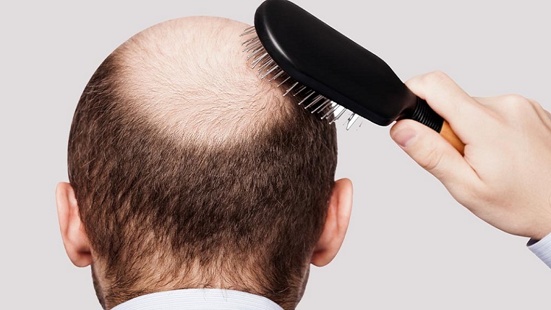 بهترین داروی ضد ریزش مو و بررسی قرص های تقویت کننده مو