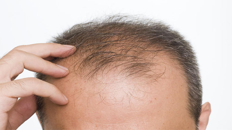 جلوگیری از ریزش مو با 13 ماده غذایی مفید