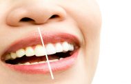 سفید کردن دندان ها در خانه با چند روش طبیعی
