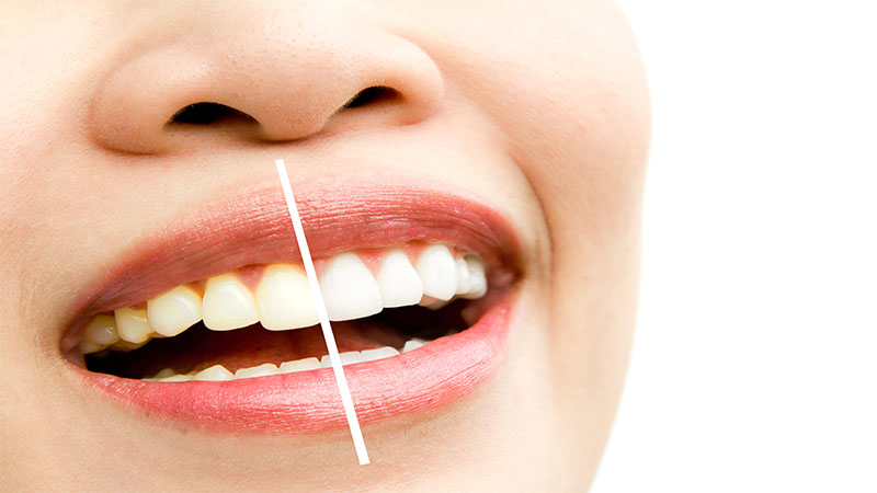 سفید کردن دندان ها با روش های طبیعی