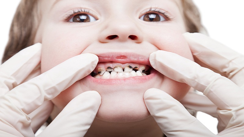 پوسیدگی دندان در کودکان به چه دلایلی ایجاد می شود؟